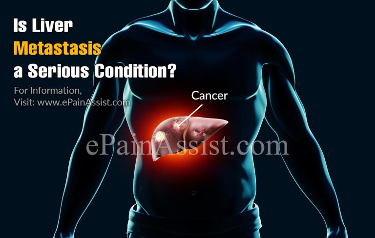 Is Liver Metastasis A Serious Condition?