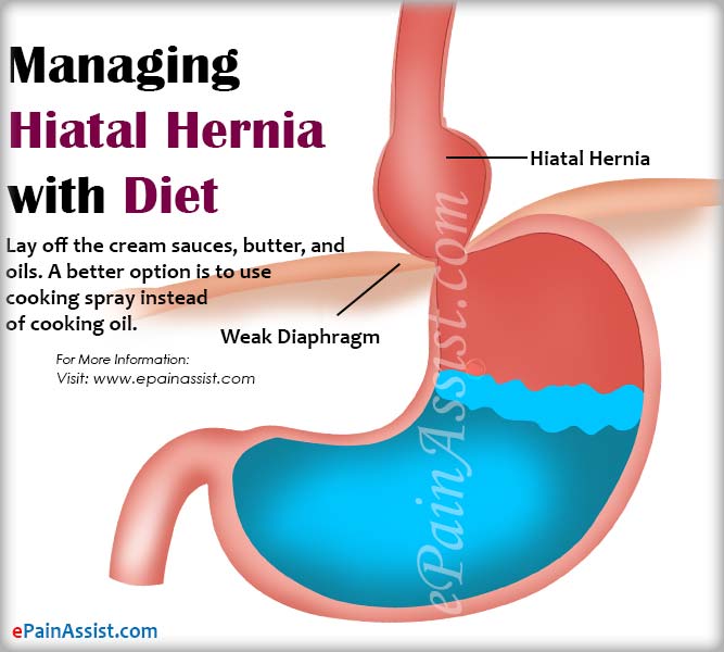 Managing Hiatal Hernia with Diet