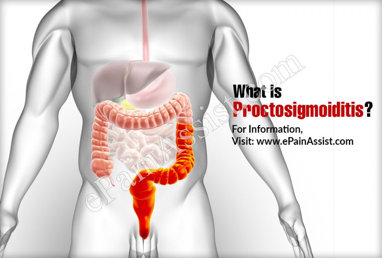 Proctosigmoiditis: Causes, Symptoms, Treatment, Complications