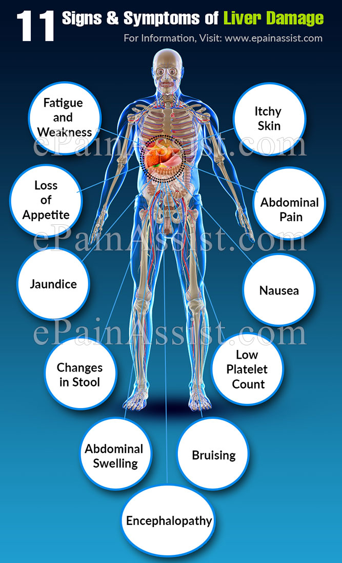 11 Signs And Symptoms Of Liver Damage