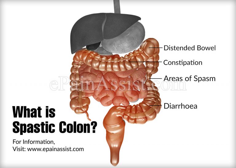 Spastic Colon: Causes, Symptoms, Treatment, Alternative Treatment, Diagnosis