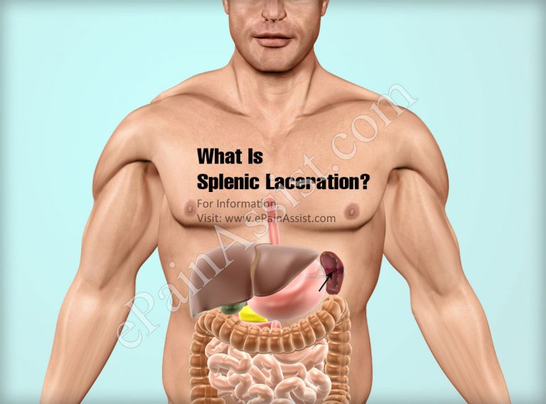 Splenic Laceration: Causes, Symptoms, Treatment