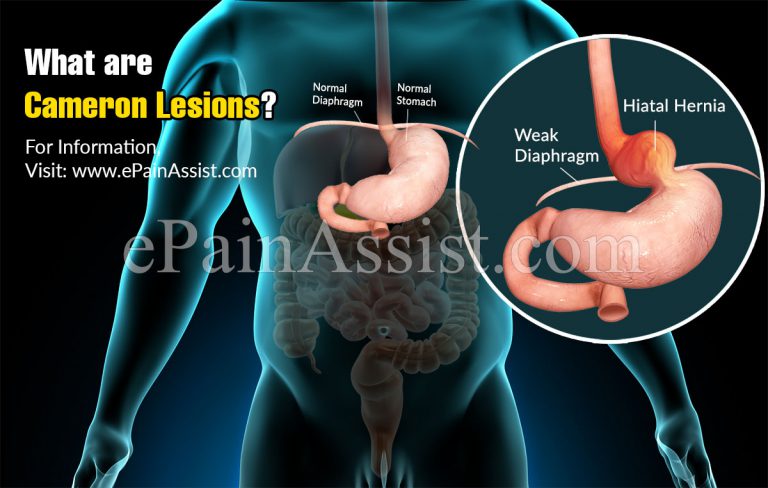 What are Cameron Lesions, Causes, Symptoms, Treatment, Natural Remedies