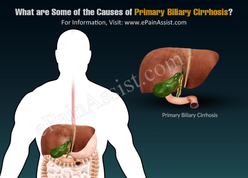 What are Some of the Causes of Primary Biliary Cirrhosis?