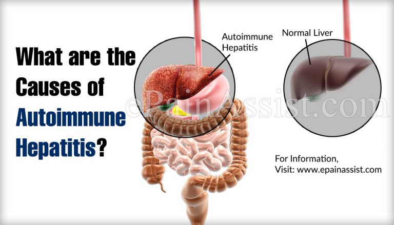 What are the Causes of Autoimmune Hepatitis?