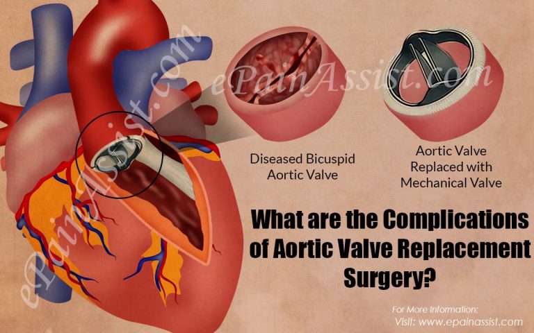 What are the Complications of Aortic Valve Replacement Surgery?