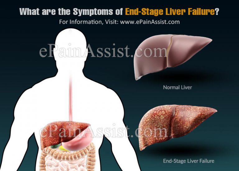 What are the Symptoms of End-Stage Liver Failure?