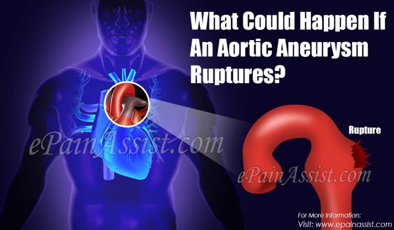 What Could Happen If An Aortic Aneurysm Ruptures?