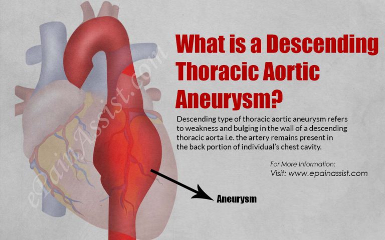 What is a Descending Thoracic Aortic Aneurysm?