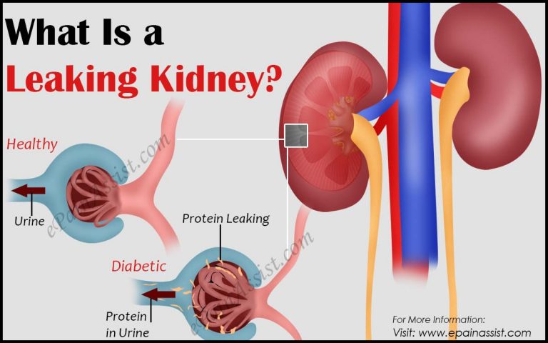 What is a Leaking Kidney & Why Do You Need To Treat A Leaking Kidney and How?