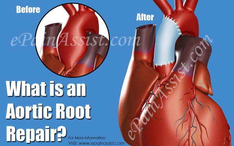 What is an Aortic Root Repair?