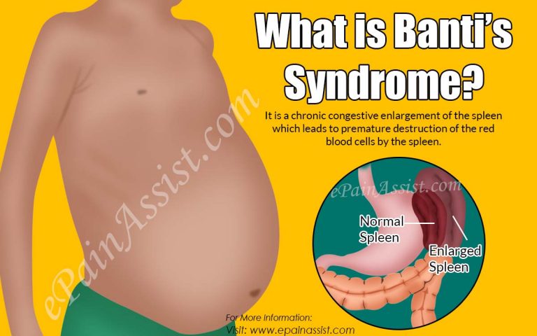 What is Banti’s Syndrome: Causes, Symptoms, Treatment, Diagnosis, Diseases Similar to Banti’s Syndrome