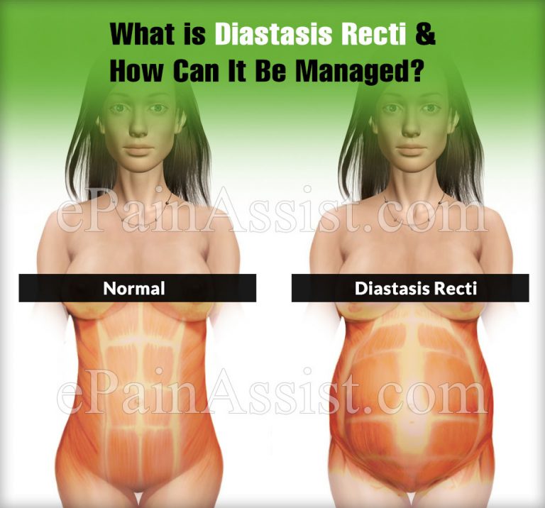 What is Diastasis Recti & How Can It Be Managed?| Causes, Symptoms, Complications of Diastasis Recti