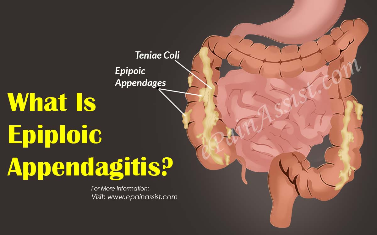 What Is Epiploic Appendagitis How Is It Treated 