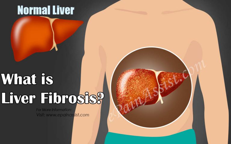 What is Liver Fibrosis: Stages, Causes, Symptoms, Treatment, Diagnosis