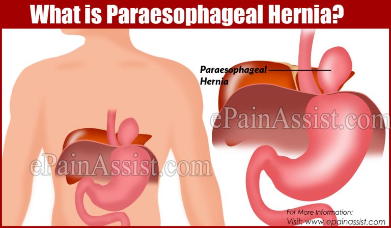What is Paraesophageal Hernia: Causes, Stages, Symptoms, Treatment, Prognosis, Prevention