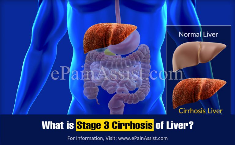 What is Stage 3 Cirrhosis of Liver?