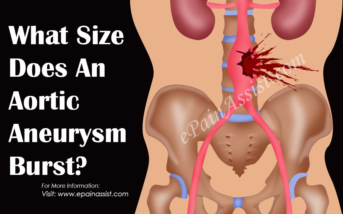 What Size Does An Aortic Aneurysm Burst?