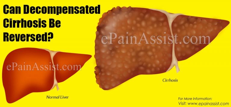 Can Decompensated Cirrhosis Be Reversed?