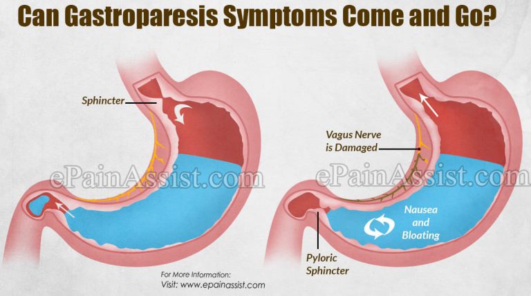 Can Gastroparesis Symptoms Come and Go?