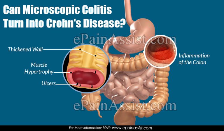Can Microscopic Colitis Turn Into Crohn’s Disease?