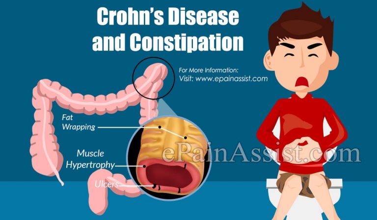 Crohn’s Disease and Constipation : Remedies for Crohn’s Constipation