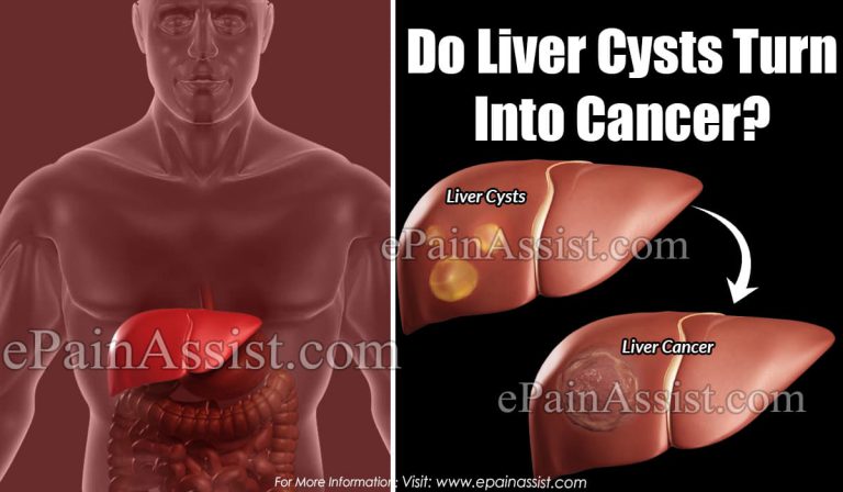 Do Liver Cysts Turn Into Cancer?