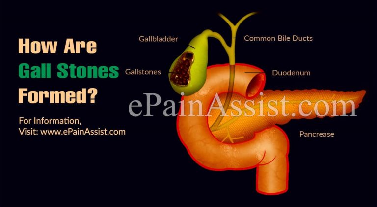 How Are Gall Stones Formed & How To Prevent Them?