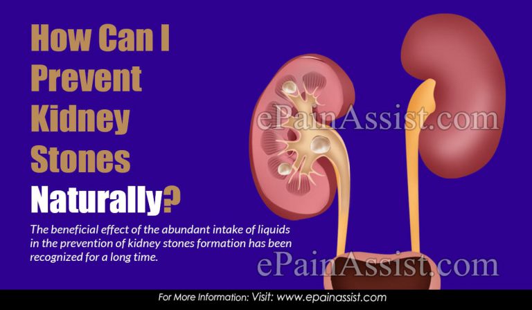 How Can I Prevent Kidney Stones Naturally?