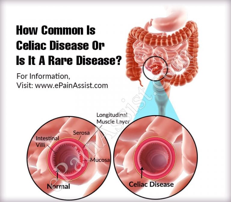 How Common Is Celiac Disease Or Is It A Rare Disease?