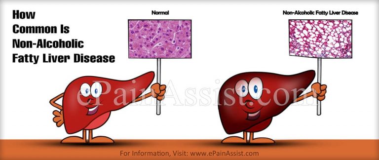 How Common Is Non-Alcoholic Fatty Liver Disease Or Is It A Rare Disease?