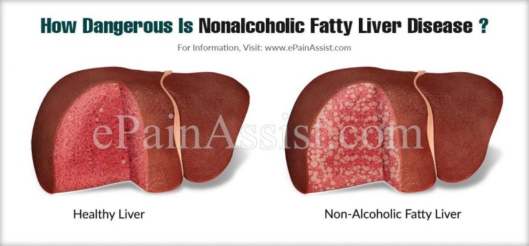 How Dangerous Is Nonalcoholic Fatty Liver Disease & Is It Contagious?
