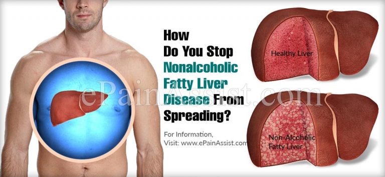 How Do You Stop Nonalcoholic Fatty Liver Disease From Spreading?