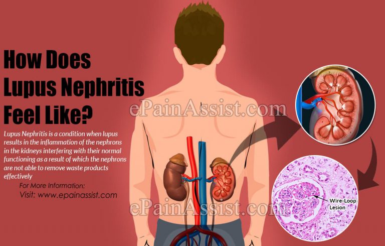 How Does Lupus Nephritis Feel Like?