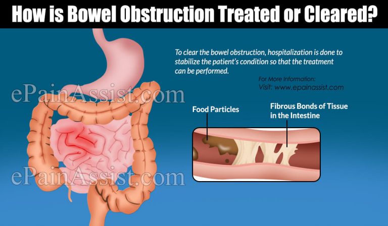 How is Bowel Obstruction Treated or Cleared?