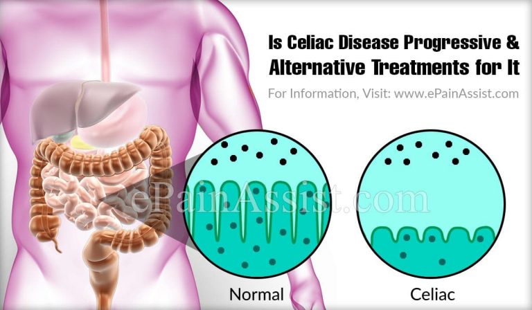 Is Celiac Disease Progressive & Alternative Treatments for It