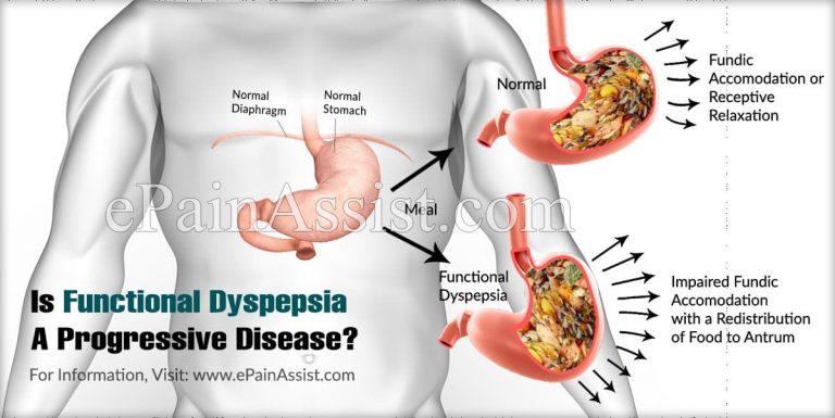 Is Functional Dyspepsia A Progressive Disease & Alternative Treatments For It?