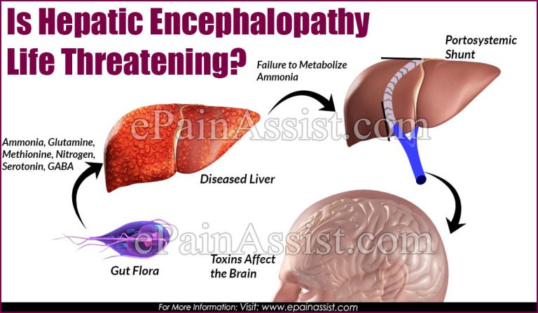 Is Hepatic Encephalopathy Life Threatening?