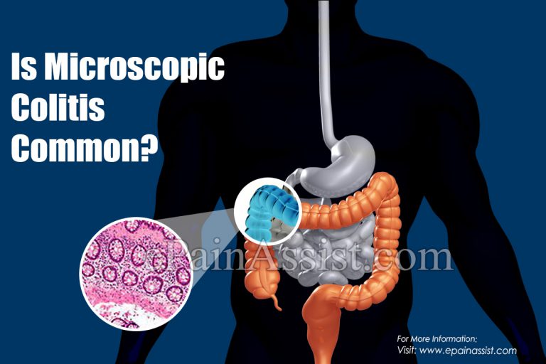 Is Microscopic Colitis Common?