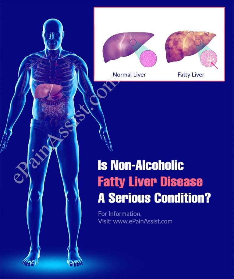 Is Non-Alcoholic Fatty Liver Disease A Serious Condition & Can It Be Reversed?