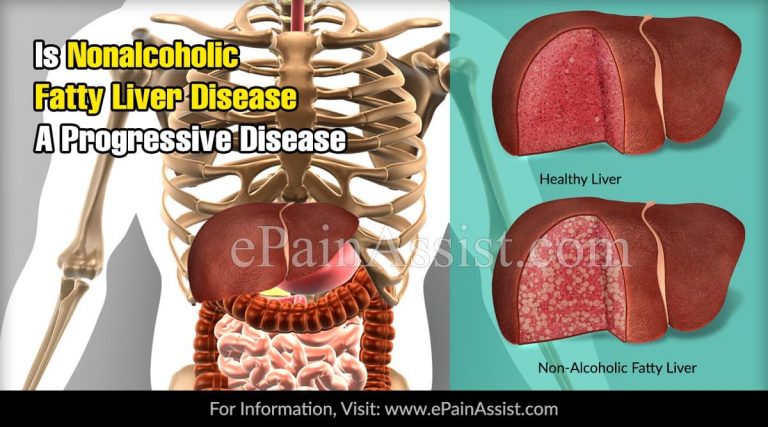 Is Nonalcoholic Fatty Liver Disease A Progressive Disease & Alternative Treatments For It?