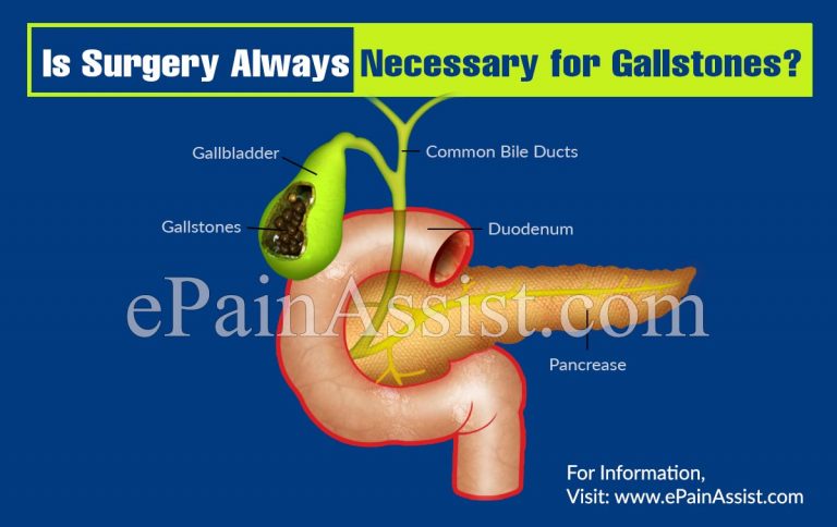 Is Surgery Always Necessary for Gallstones?