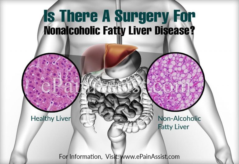Is There A Surgery For Nonalcoholic Fatty Liver Disease?