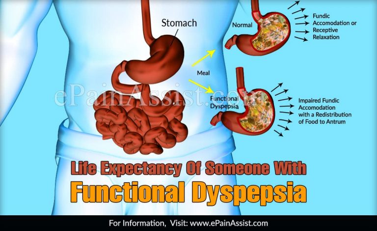 Life Expectancy Of Someone With Functional Dyspepsia & Is It A Disability?