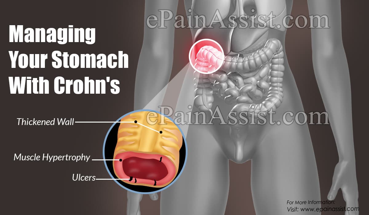 Managing Your Stomach With Crohn's