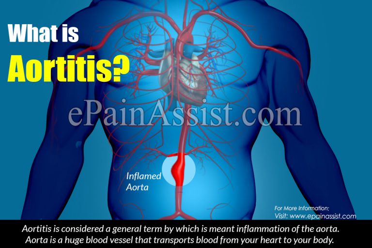 Aortitis: Symptoms, Causes, Treatments, Complications