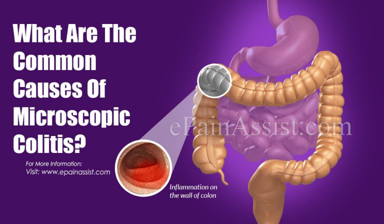 What Are The Common Causes Of Microscopic Colitis?