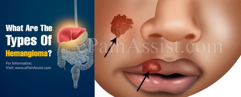 What Are The Types Of Hemangioma?
