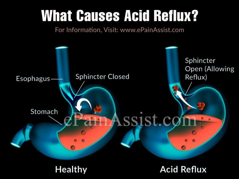 What Causes Acid Reflux? | Diet and Lifestyle Tips to Overcome Acid Reflux