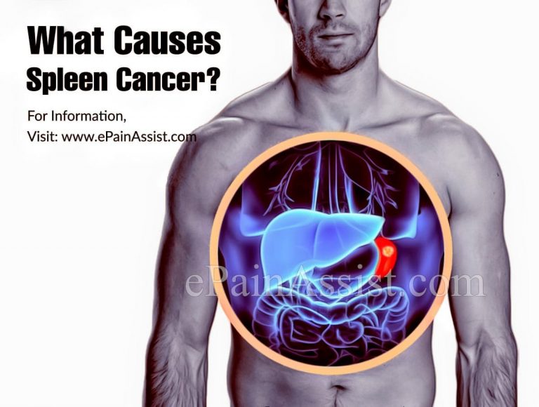 Spleen Cancer: Causes & Treatment